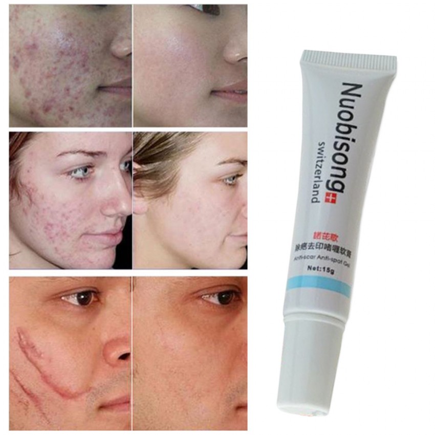 Рубцы от прыщей: средства для устранения шрамов и советы по восстановлению кожи медицинскими и народными средствами (110 фото)