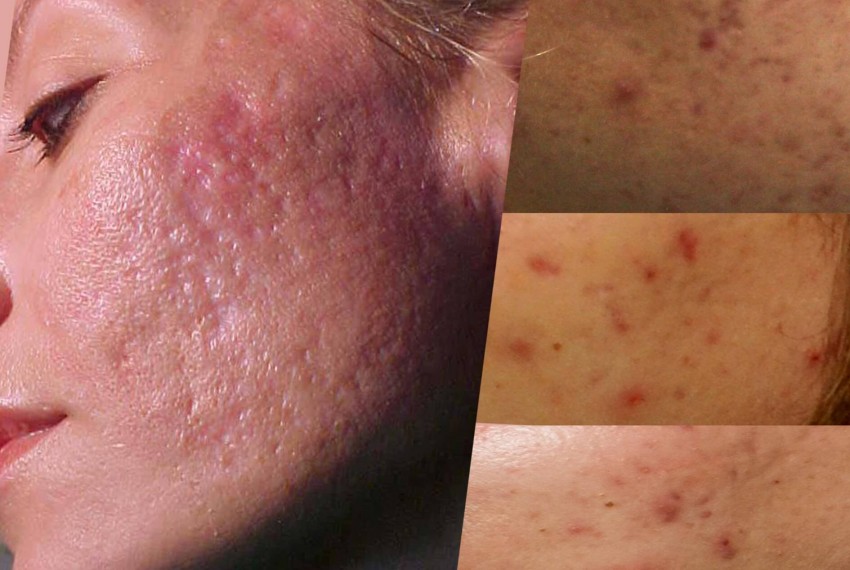 Рубцы от прыщей: средства для устранения шрамов и советы по восстановлению кожи медицинскими и народными средствами (110 фото)