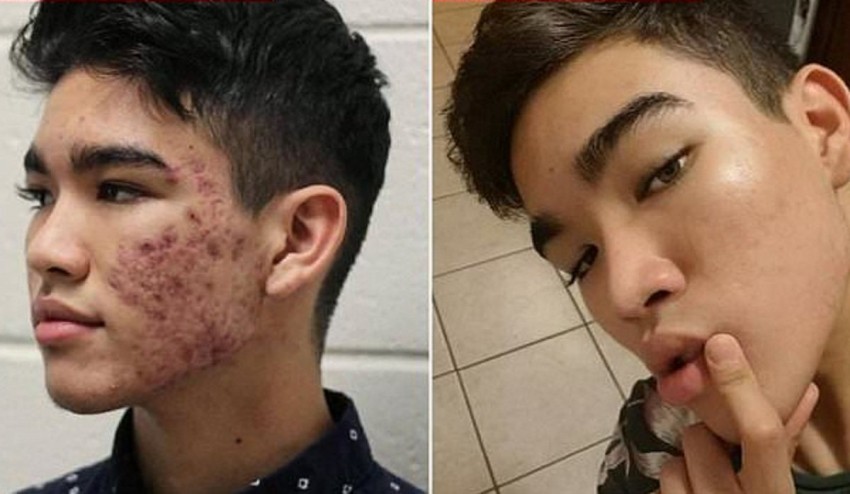 Таблетки от прыщей: ТОП рейтинг самых эффективных средств и список рекомендованных производителей лекарств (125 фото)