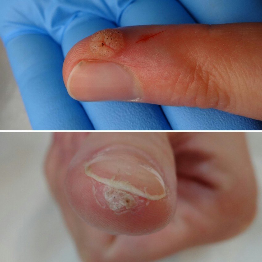 Удаление бородавок лазером - описание процедуры, советы по выбору специалиста, цены, эффективность и отзывы врачей (135 фото и видео)