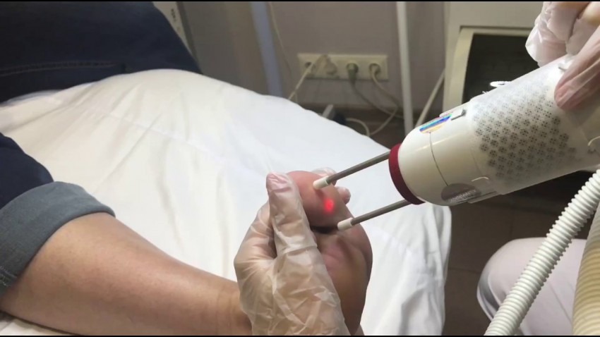 Удаление бородавок лазером - описание процедуры, советы по выбору специалиста, цены, эффективность и отзывы врачей (135 фото и видео)