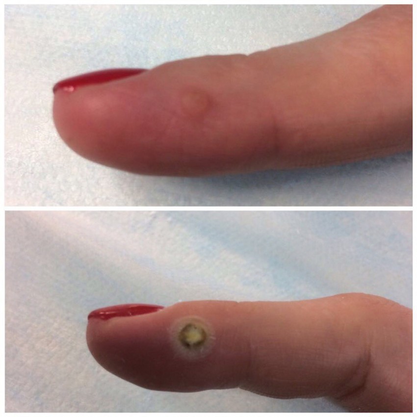 Удаление бородавок лазером - описание процедуры, советы по выбору специалиста, цены, эффективность и отзывы врачей (135 фото и видео)