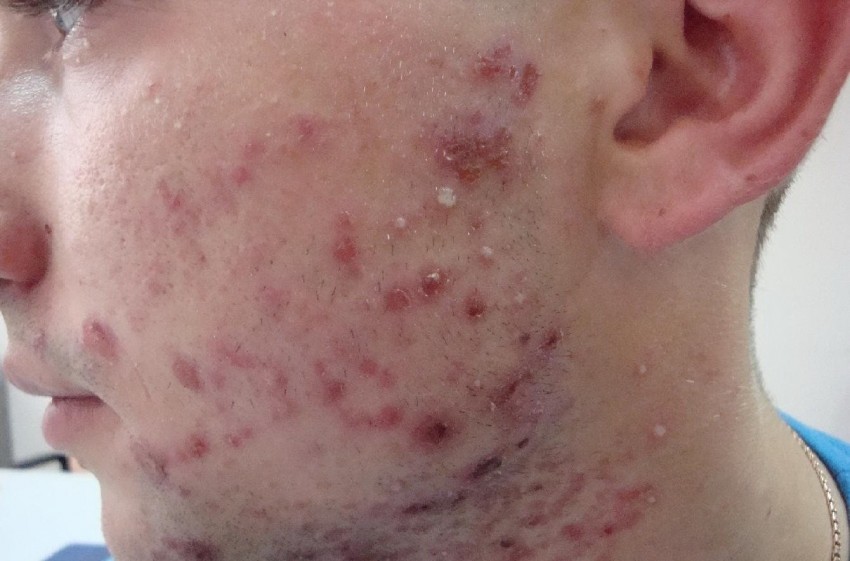 Ветрянка у взрослых: 140 фото, основные симптомы, первые признаки и этапы лечения