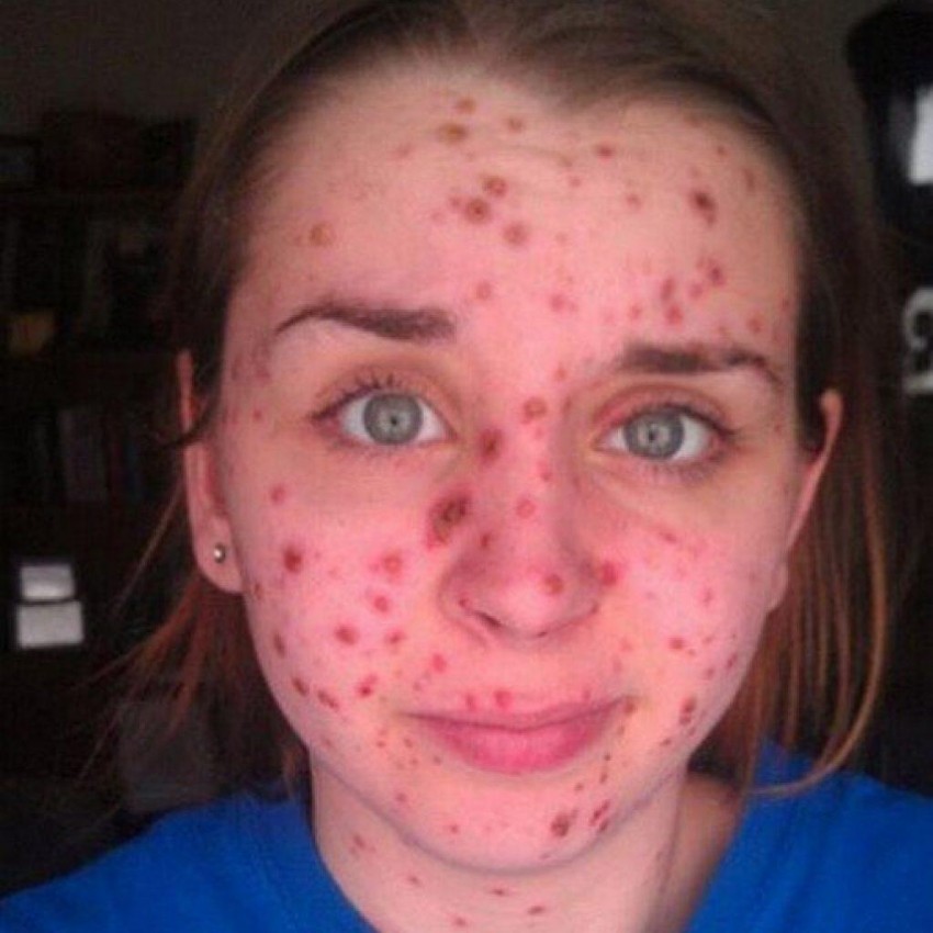 Ветрянка у взрослых: 140 фото, основные симптомы, первые признаки и этапы лечения